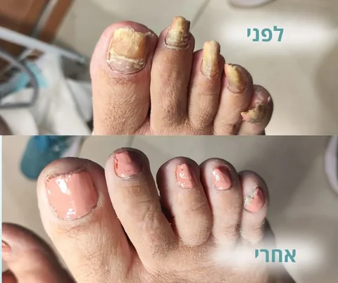 לפני ואחרי שיקום אסתטי של ציפורני הרגליים