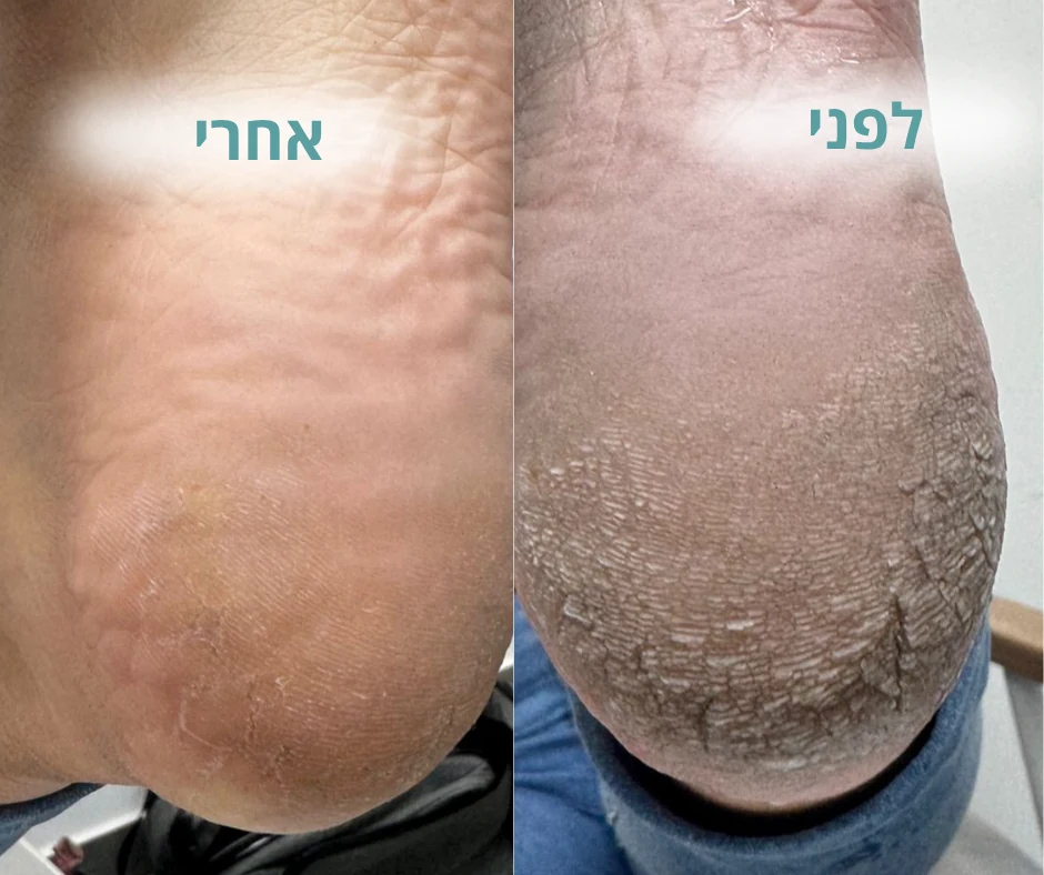 לפני ואחרי טיפול בעקב יבש וסדוק עם עור קשה