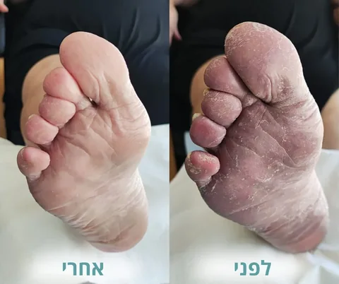 לפני ואחרי טיפול בעור יבש ומתקלף בכף הרגל