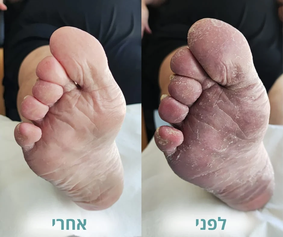 לפני ואחרי טיפול בעור יבש ומתקלף בכף הרגל