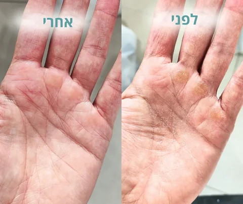 לפני ואחרי טיפול בעור יבש ומעובה בכף היד