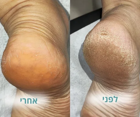 לפני ואחרי טיפול להפחתת עור קשה ויבש בעקב