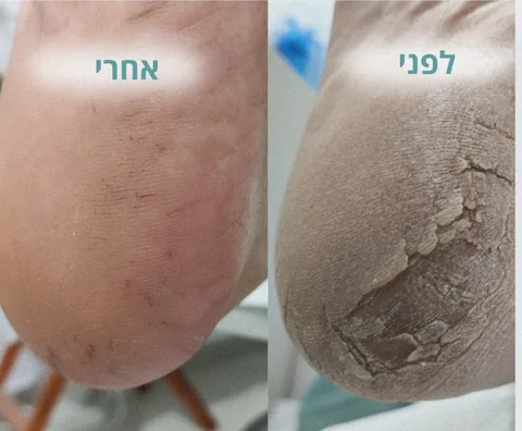 לפני ואחרי טיפול בסדקים עמוקים בעקב