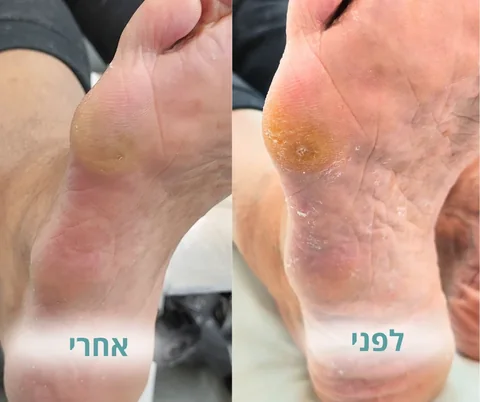 לפני ואחרי טיפול ביבלת לחץ בכף הרגל