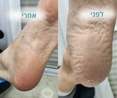 לפני ואחרי טיפול בעור יבש ומתקלף בכף הרגל