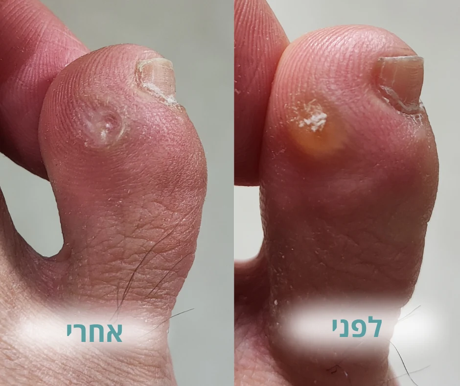 לפני ואחרי טיפול ביבלת באצבע הרגל
