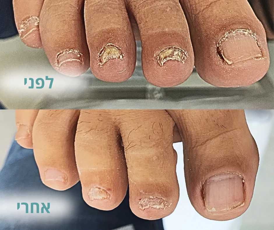 לפני ואחרי ניקוי ושיקום ציפורני הרגליים